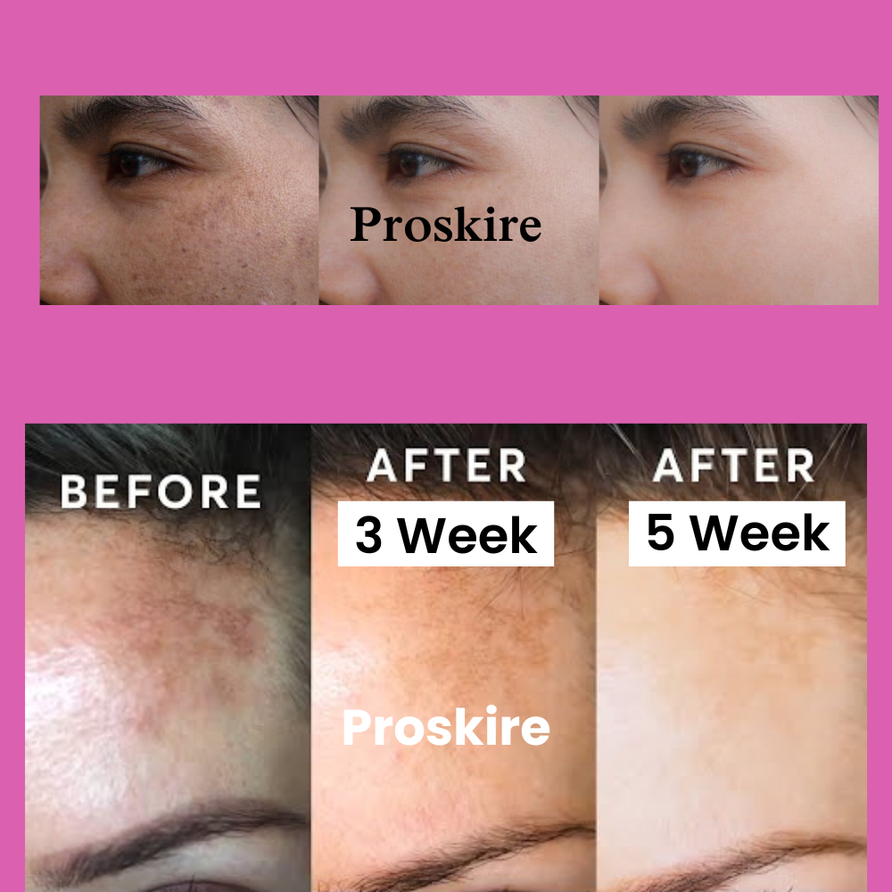 0.3% Retinol Serum Wrinkle, Fine Line & Freckle Treatment