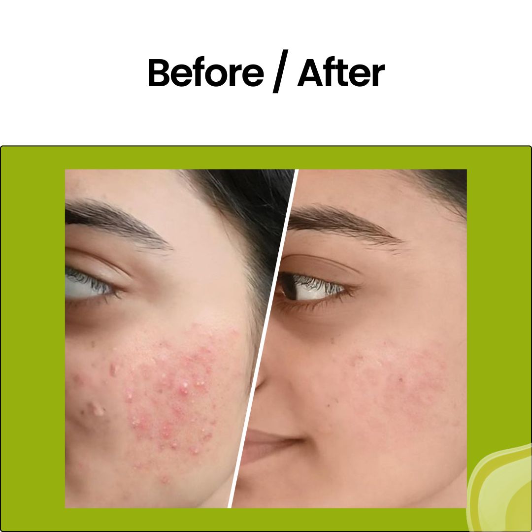 2% Salicylic Acid Serum Acne, Blackhead & Pore Treatment