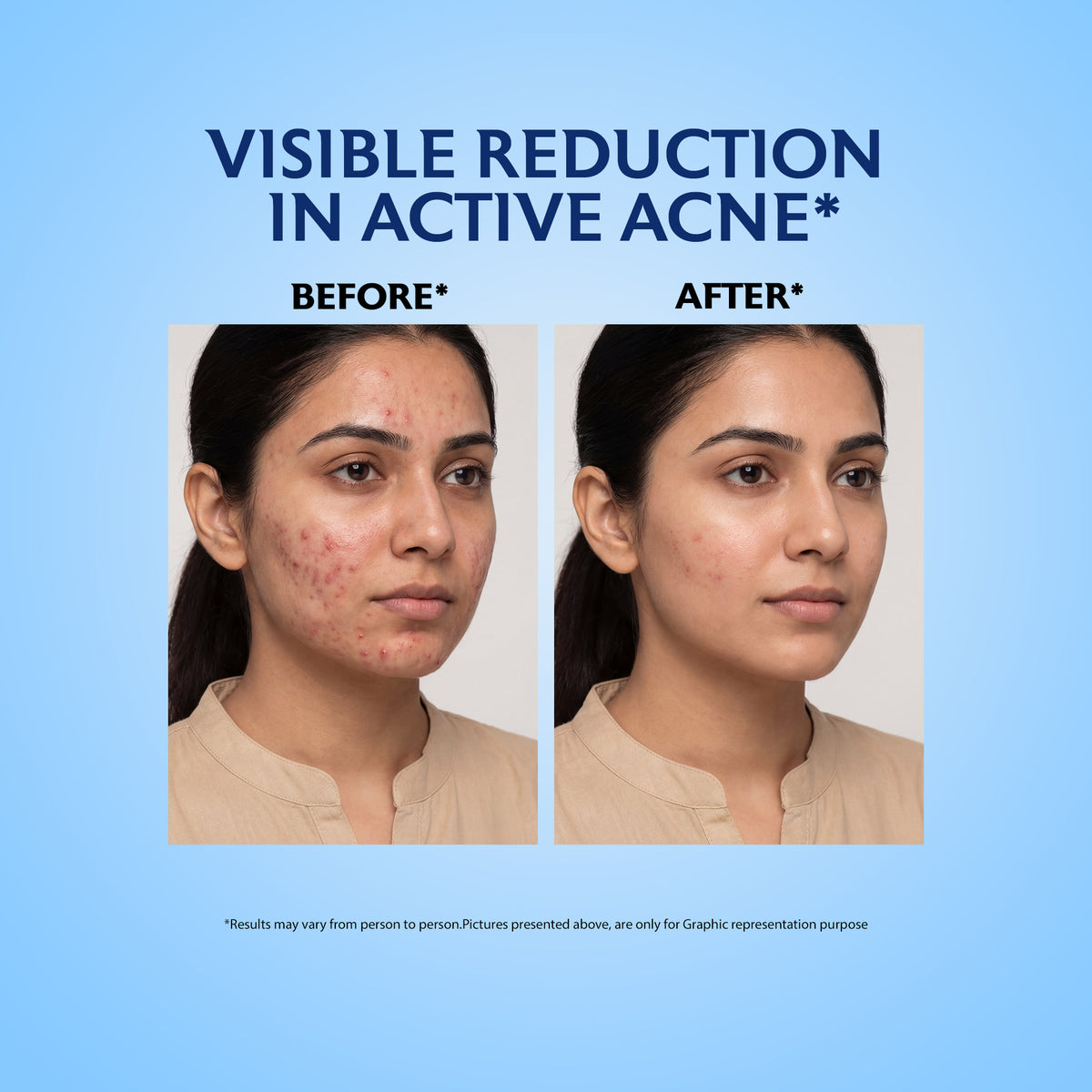 Acne Spot Gel for Pimples, Blackheads & Breakouts 20g — 4