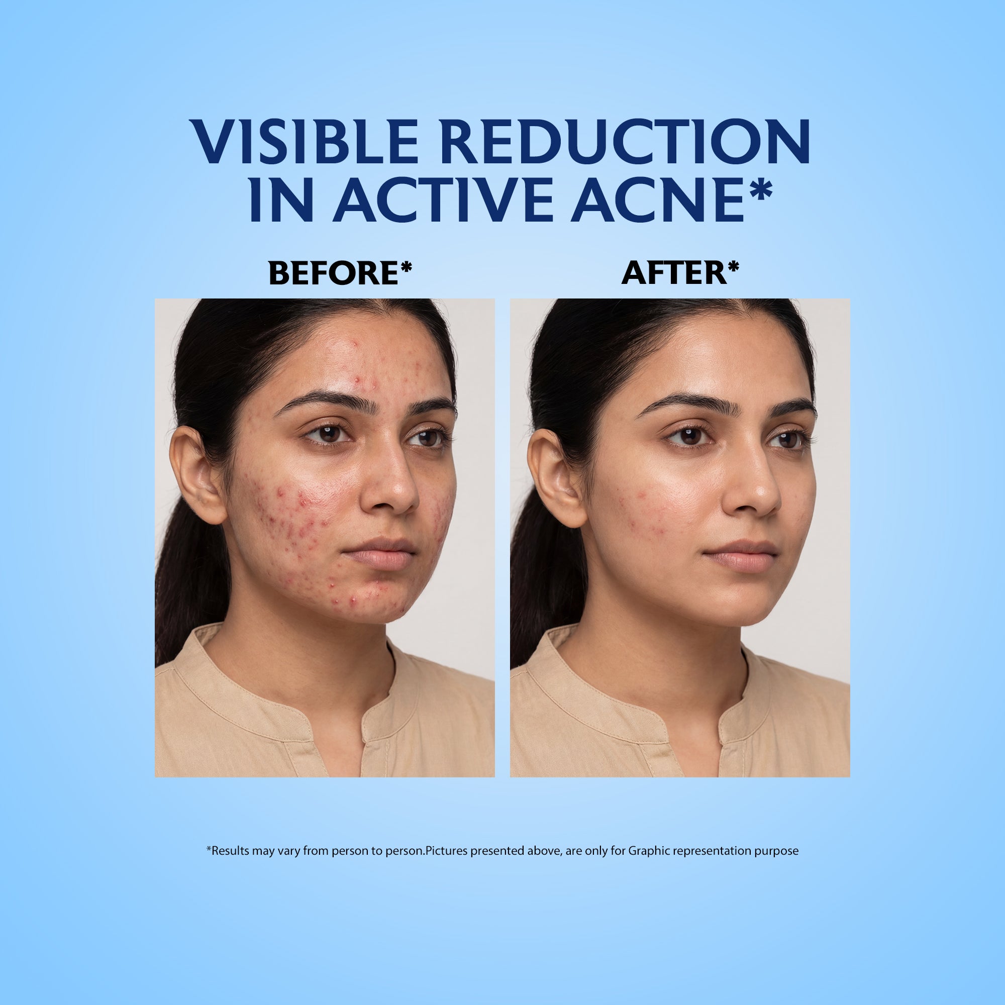 Acne Spot Gel for Pimples, Blackheads & Breakouts (20gm)