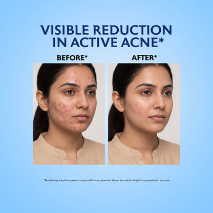 Acne Spot Gel for Pimples, Blackheads & Breakouts 20g