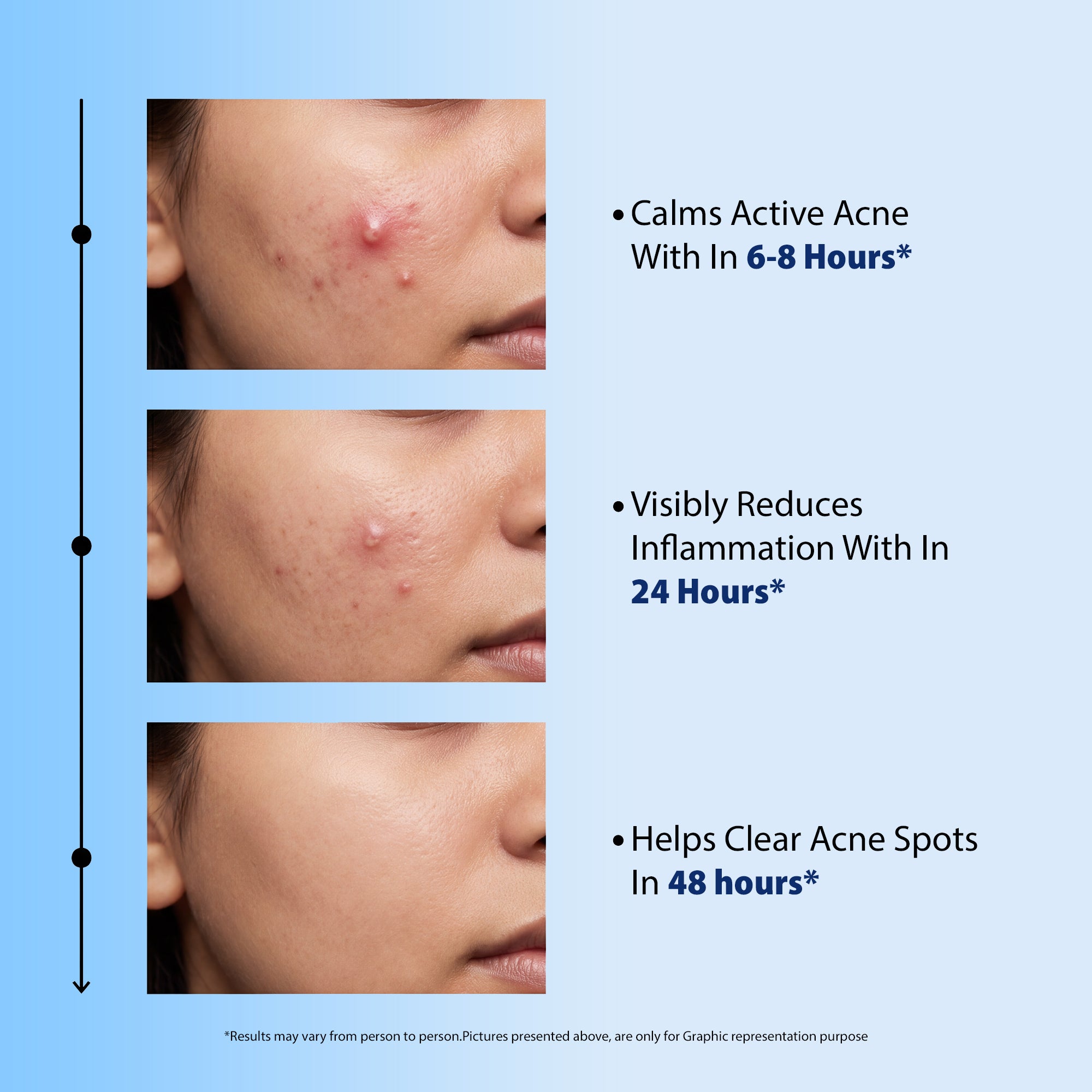 Acne Spot Gel for Pimples, Blackheads & Breakouts (20gm)