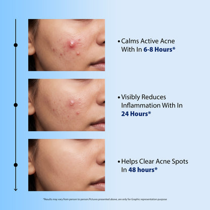 Acne Spot Gel for Pimples, Blackheads & Breakouts 20g